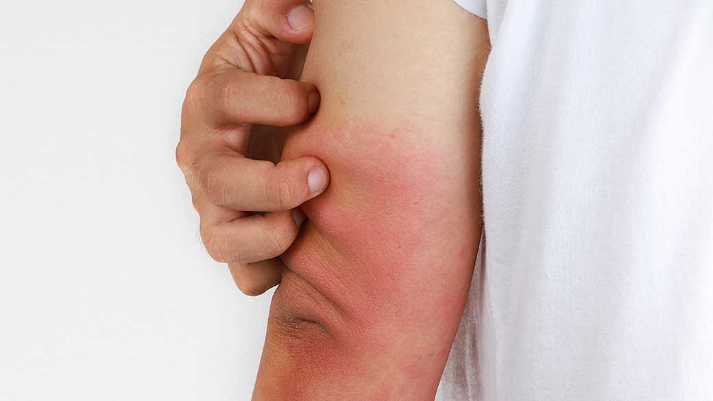 A complete guide to eczema for both beginners and long-term patients by Dr John O’Shea and Jason Humphries, founders of Good Pharma Dermatology and Suu Balm