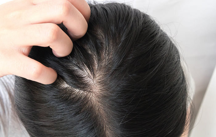 Want To Fix Your Oily Scalp Problems? Here's What You Need To do