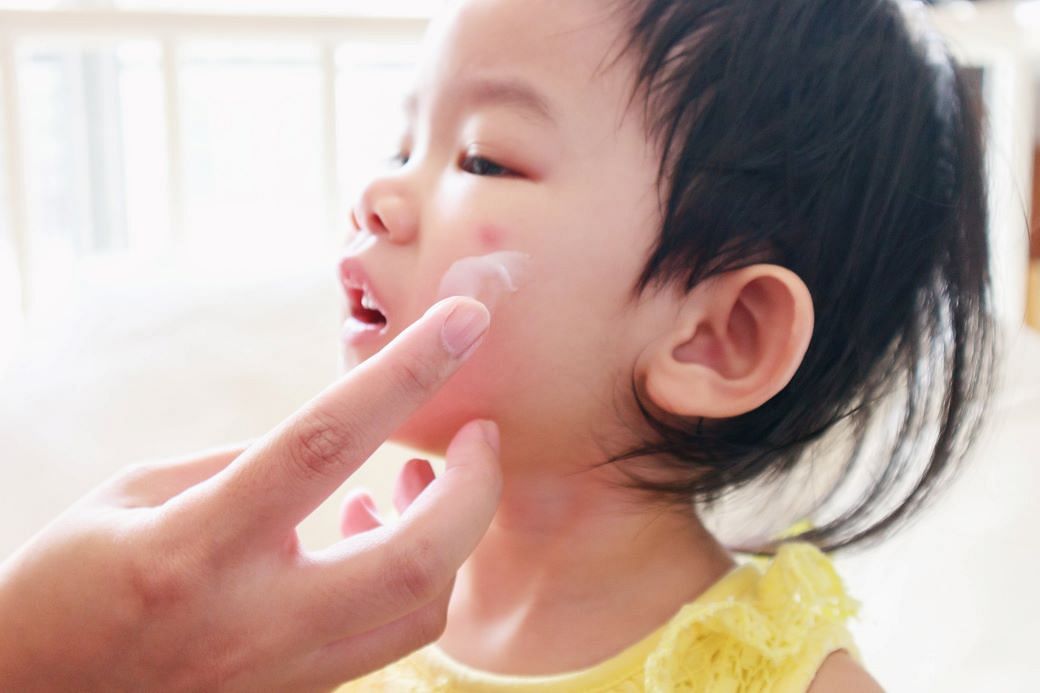Facial Eczema: Dermatologists on How to Treat, Manage, and Prevent It