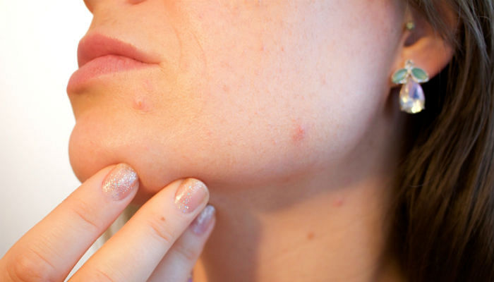 The One Thing Which Could Be Causing Pimple Outbreaks - Featured 1